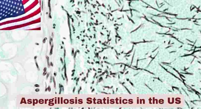 Aspergillosis Statistics in the US 2025 | Mortality & Survival Stats