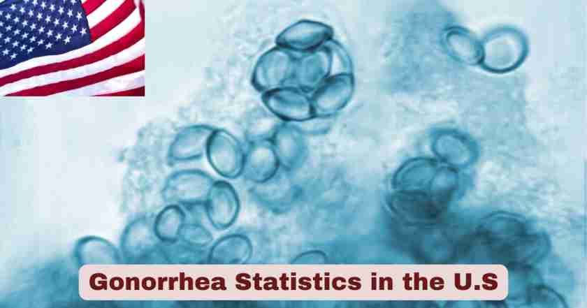 Gonorrhea Statistics in US 2025 | Facts about Gonorrhea