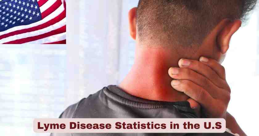 Lyme Disease Statistics in the U.S. 2025 | Facts about Lyme