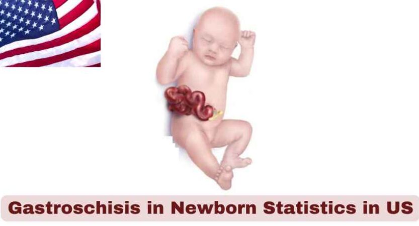 Gastroschisis in Newborn Statistics in US 2025 | Key Facts