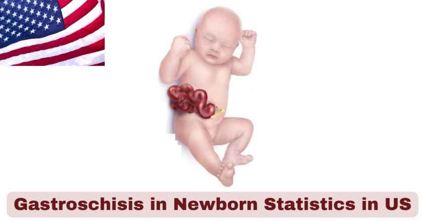 Gastroschisis in Newborn Statistics in US 2025 | Key Facts