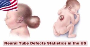 Neural Tube Defects Statistics in US 2025 | Key Facts