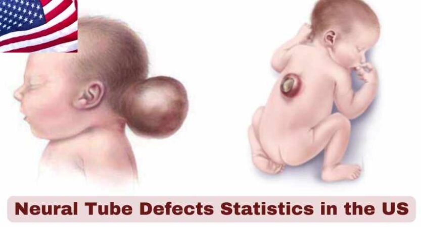 Neural Tube Defects Statistics in US 2025 | Key Facts