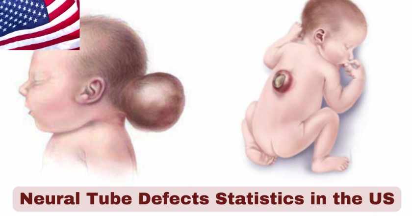 Neural Tube Defects Statistics in US 2025 | Key Facts
