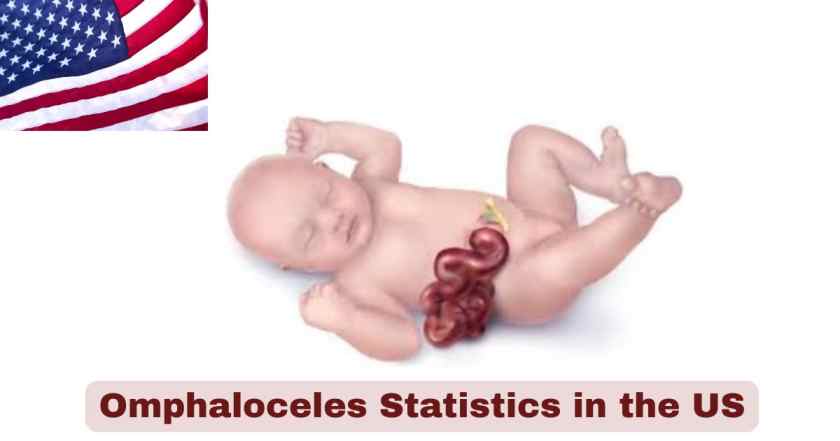 Omphaloceles Statistics in the US 2025 | Facts about Omphaloceles