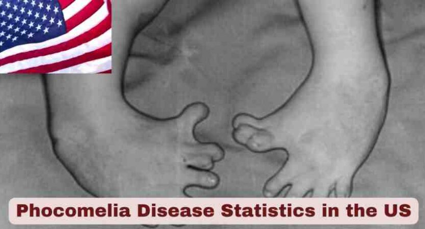 Phocomelia Disease Statistics in US 2025 | Key Facts