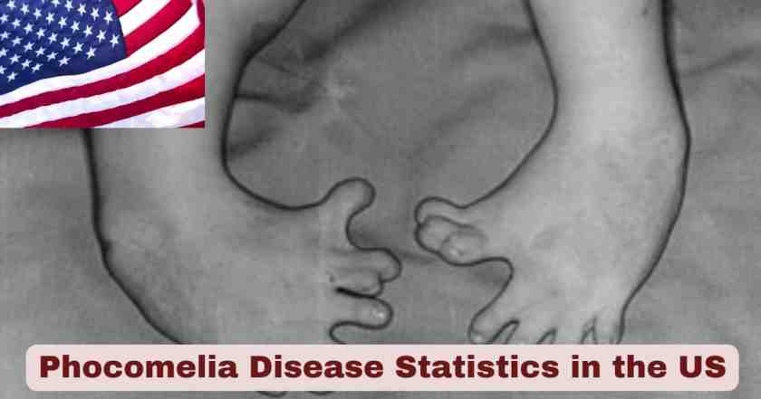 Phocomelia Disease Statistics in US 2025 | Key Facts
