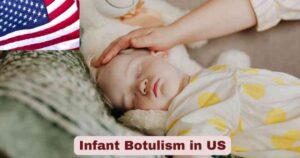 Infant Botulism Statistics in US 2025 | Botulism Case Facts
