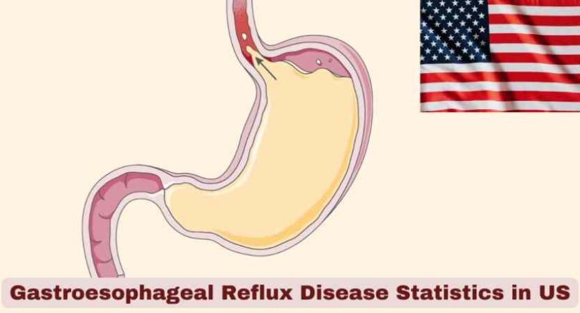 Gastroesophageal Reflux Disease Statistics in US 2025 | Key Facts