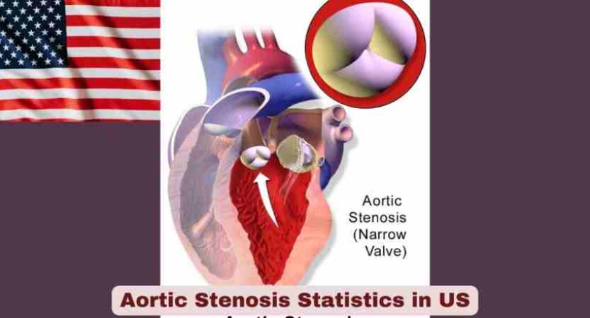 Aortic Stenosis Statistics in US | Key Facts