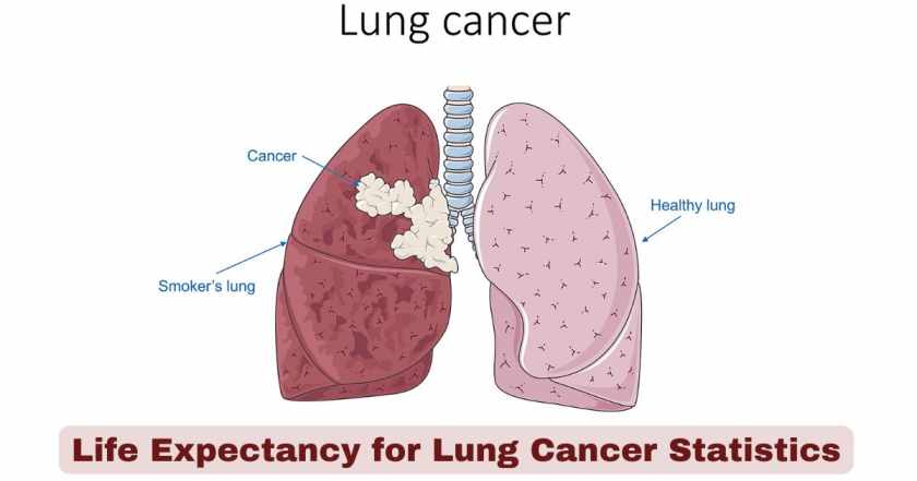 Life Expectancy for Lung Cancer Statistics 2026 | Key Facts