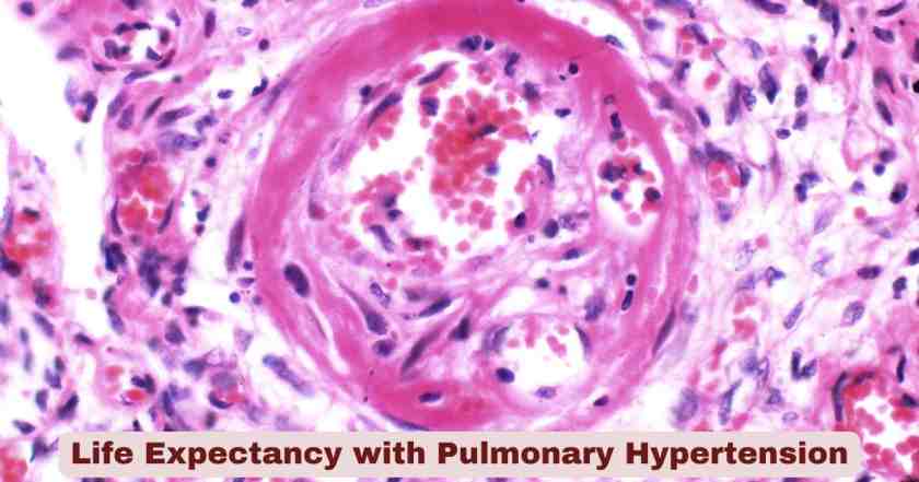 Life Expectancy with Pulmonary Hypertension 2026 | Key Facts